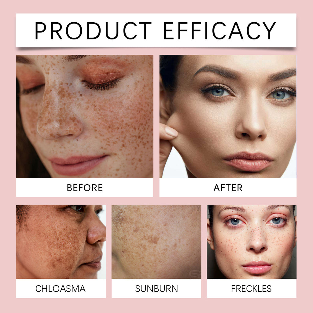 Freckle Whitening Brightening Serum, Brightening And Firming Skin Plant Extract